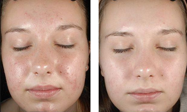 Фото 2. При проблемах с нежелательными высыпаниями на коже лица также поможет миндальный пилинг 