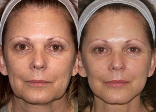 Фото 5. Особенно заметен эффект от 3D-мезонитями тредлифтинга на лице с явно выраженными признаками старения кожи