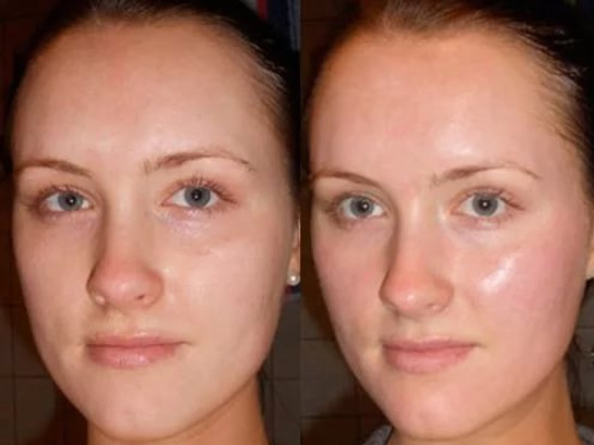 Фото 3. Если пилинг сделан правильно, то кожа приобретает естественный здоровый блеск, как на фото справа