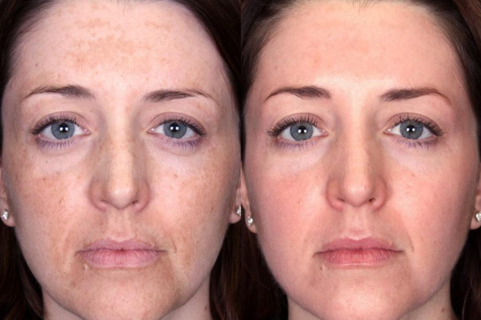 Фото 1. Если у женщин ярко выражена пигментация на коже лица - химический пилинг миндальной кислотой поможет решить проблему