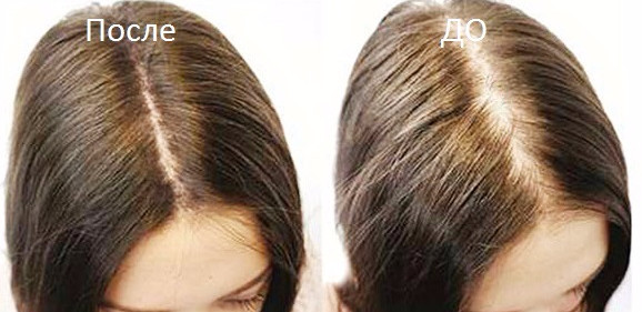 До и после дарсонвализации волос