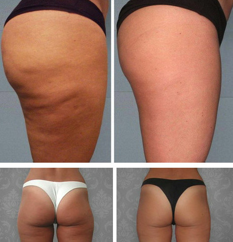 Судя по фото до и после, женщинам действительно удается вернуть себе былые формы, выровнять контур кожи